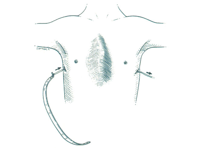 Nuss technique, from W. Lorenz Surgical catalogue