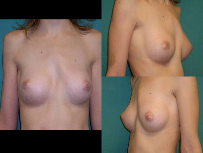 Result with mamary prosthesis without pectus surgery